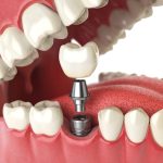 The Benefits of Choosing Dental Implants in Plymouth