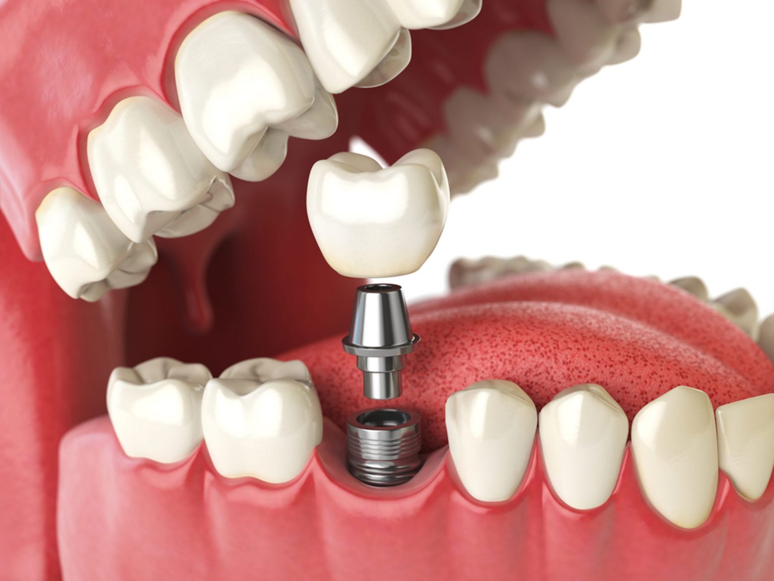 The Benefits of Choosing Dental Implants in Plymouth